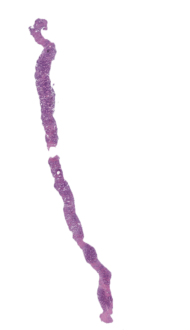 Prostata-Biopsie